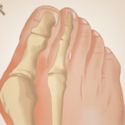 voet-hallux-valgus-anatomie voet-hallux-valgus-anatomie