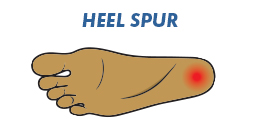 work shoes for heel spur